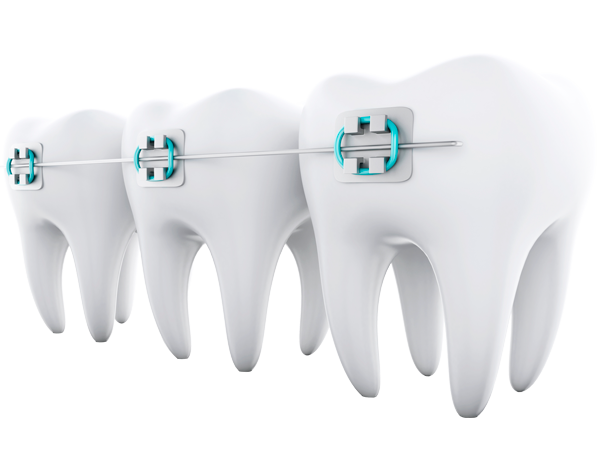 Implantes
